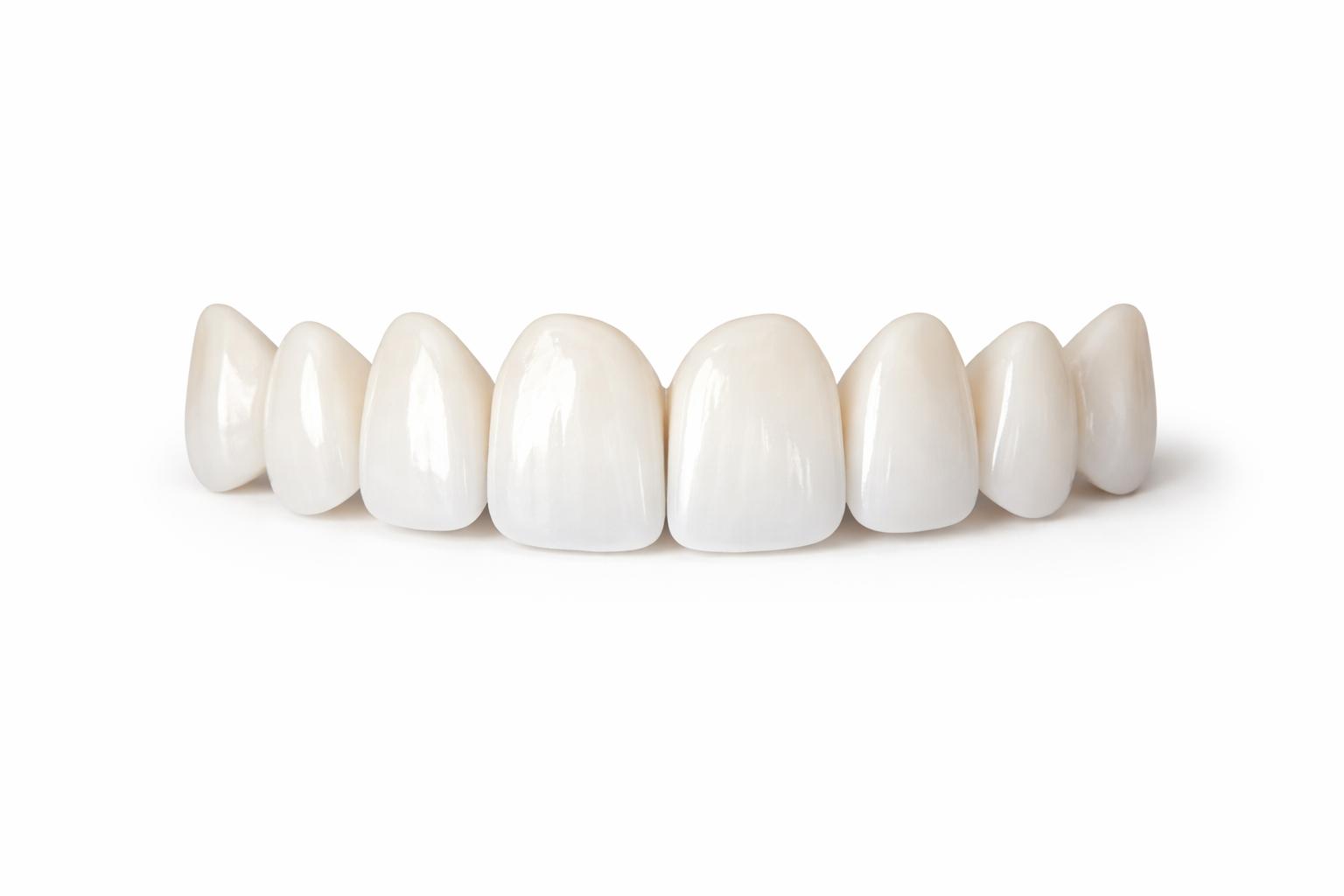 Carillas dentales estéticas con acabado natural