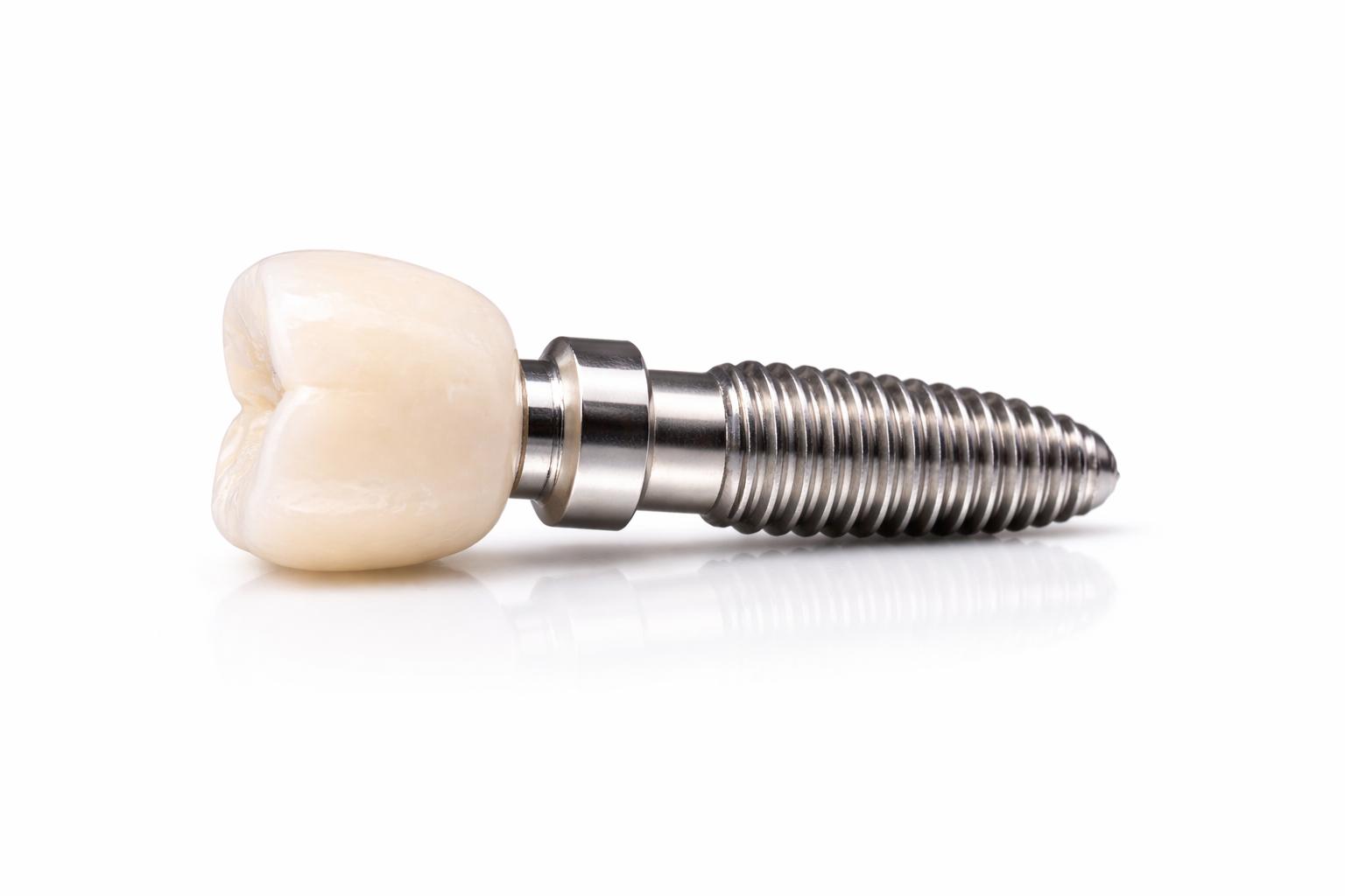 Implantes dentales con restauración estética natural