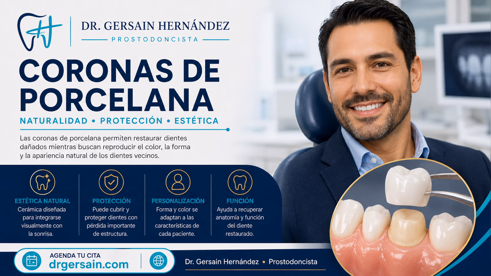 Coronas de porcelana: cómo conseguir un diente restaurado con aspecto natural