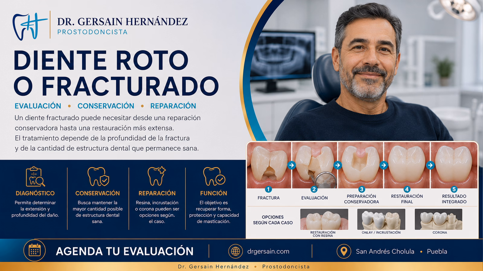 Diente roto o fracturado: qué opciones existen para repararlo