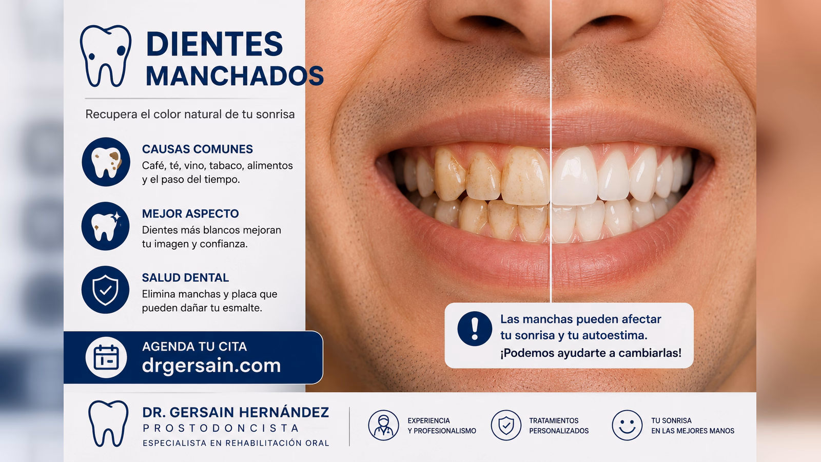 Dientes manchados: causas posibles y cuándo basta un blanqueamiento