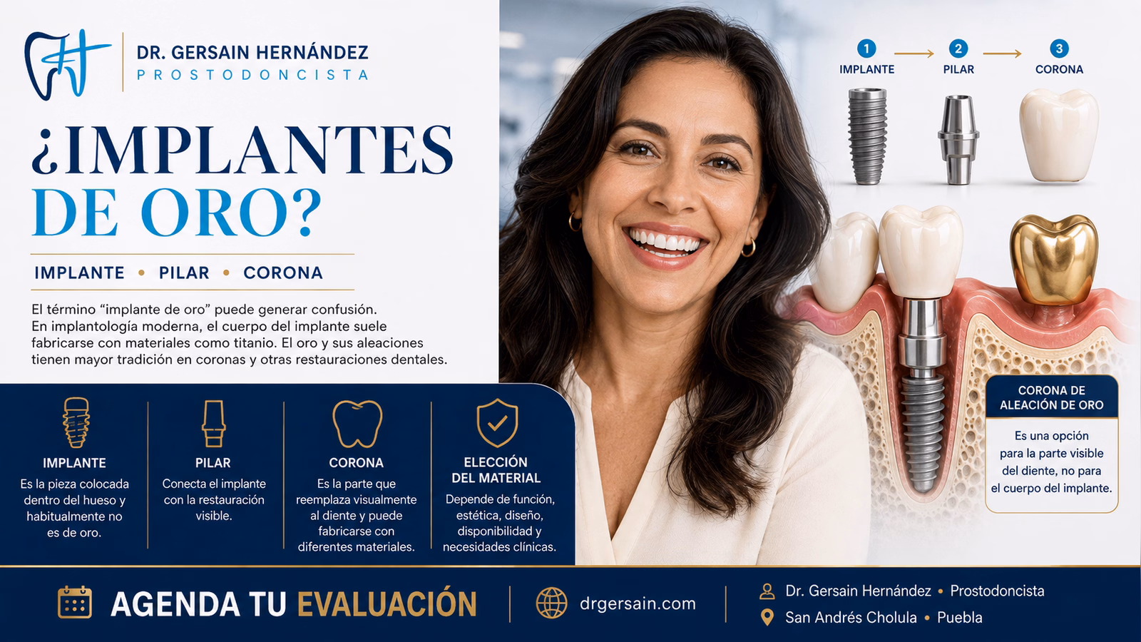 Implantes de oro: qué significa realmente esta búsqueda en odontología