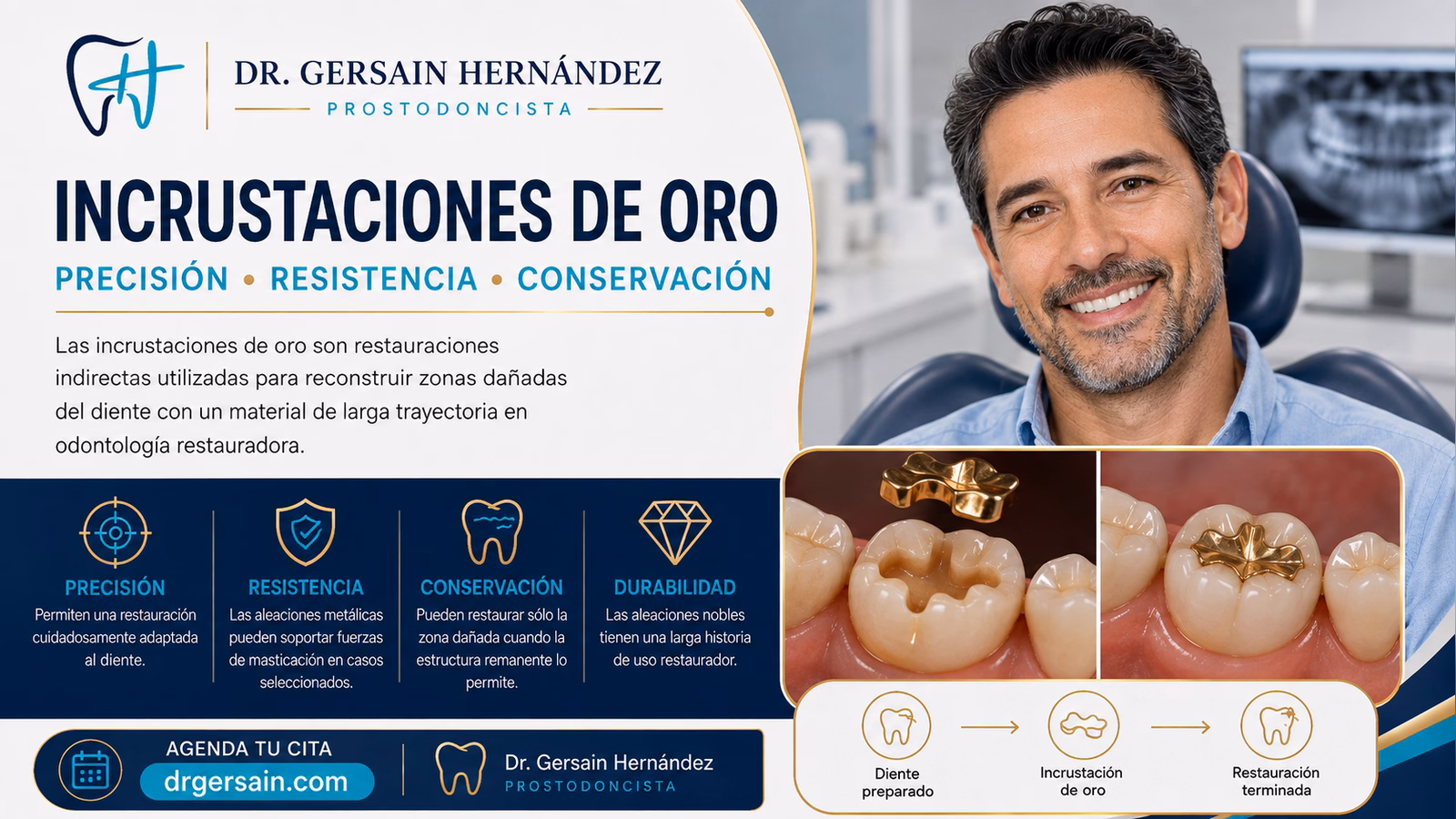 Incrustaciones de oro: durabilidad clásica y diferencias frente a materiales estéticos