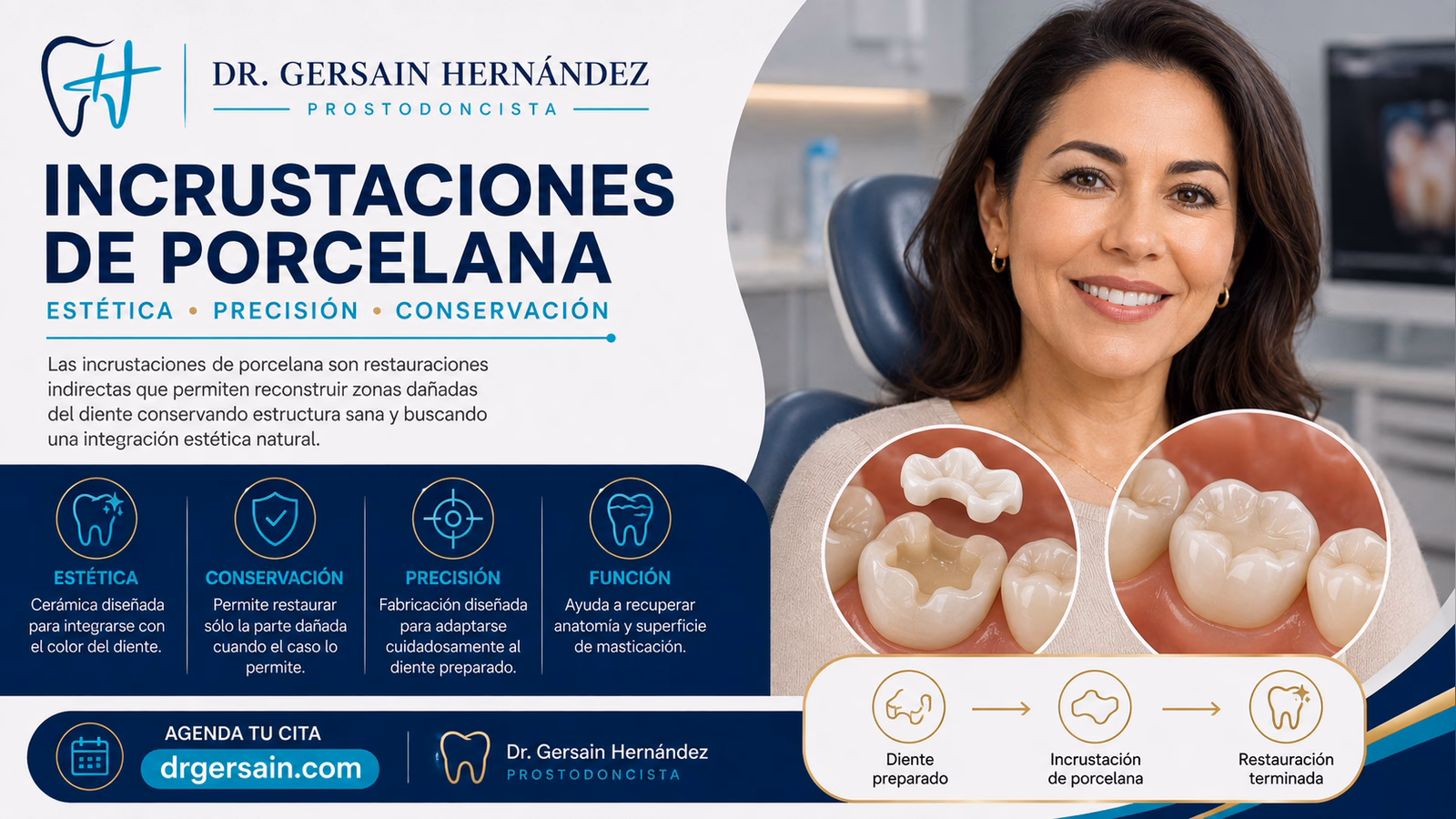 Incrustaciones de porcelana: restauraciones estéticas para dientes posteriores