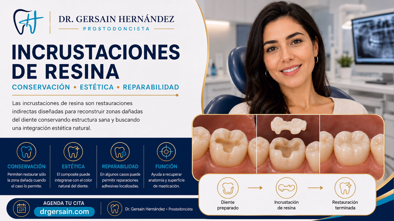Incrustaciones de resina: restauración indirecta para conservar estructura dental