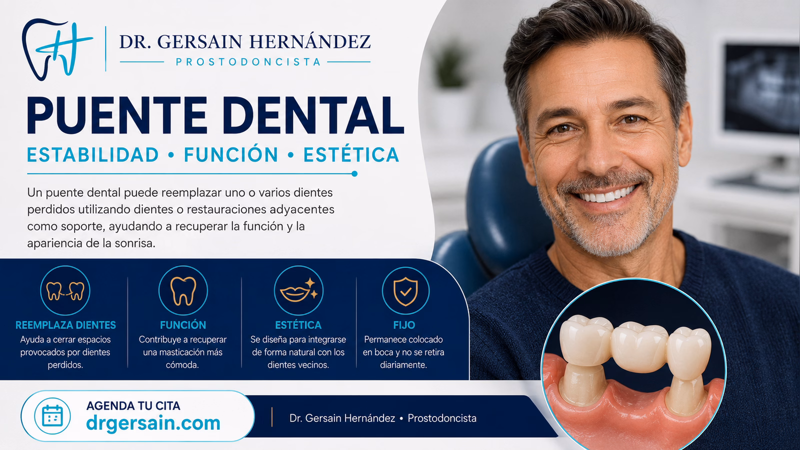 Puente dental: cómo reemplazar uno o varios dientes sin una prótesis removible