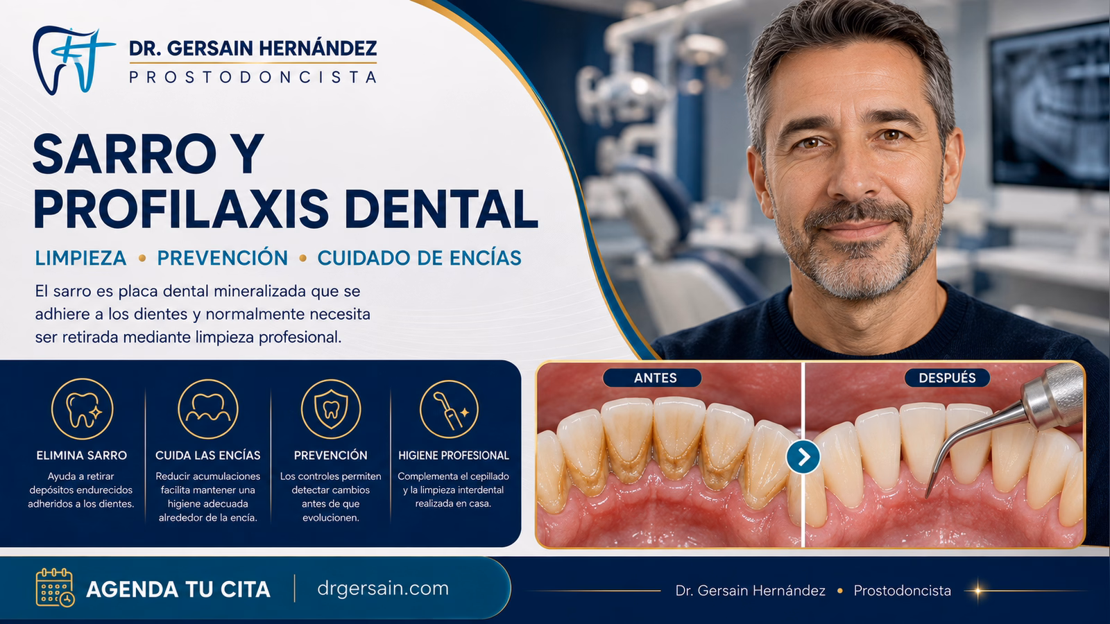 Sarro en los dientes: por qué no se elimina por completo con el cepillado